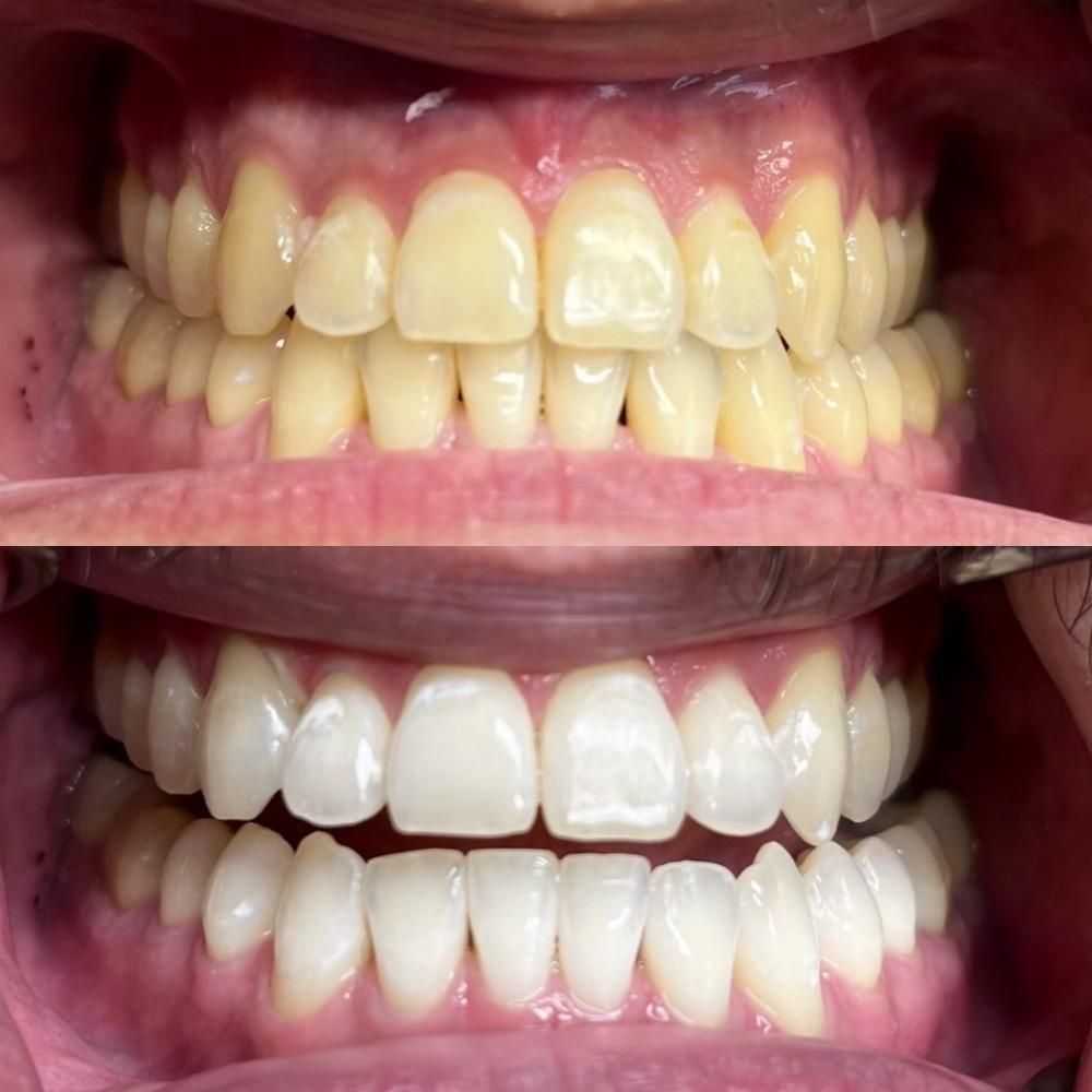 natural teeth whitening
