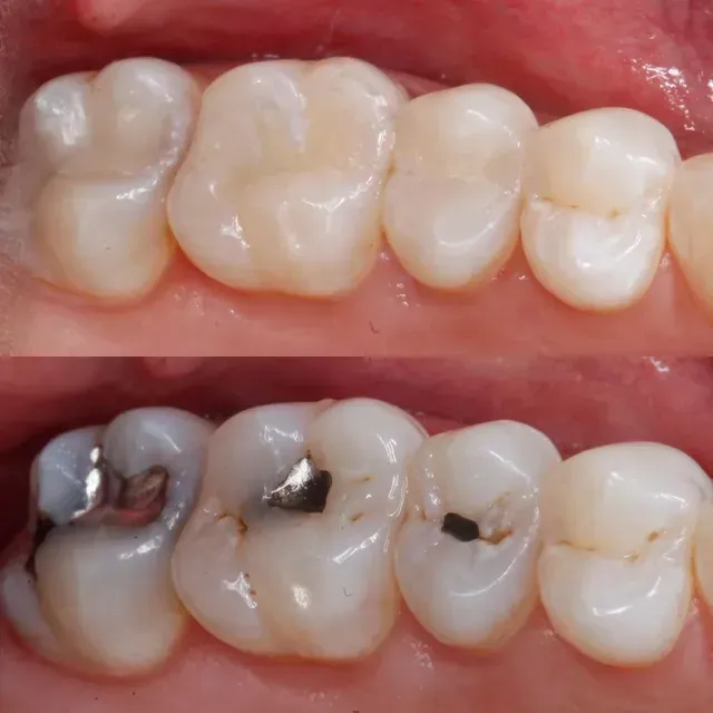 Close-up of upper and lower molars, with several silver dental fillings visible.
