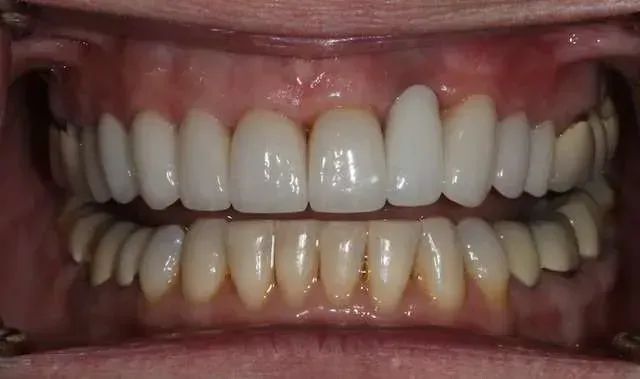Close-up of a smile showing upper and lower teeth with visible tooth discoloration on the lower row