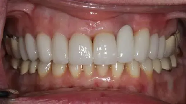 Close-up of teeth and gums, showing bright white upper teeth and slightly yellow lower teeth.