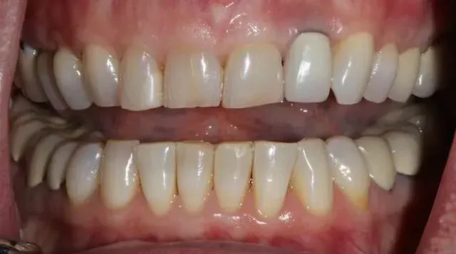 Close-up of a smiling mouth with teeth shown and lips parted, upper and lower teeth visible