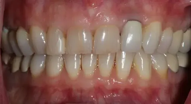 Close-up of a mouth with teeth and gums, showing a prominent upper front tooth