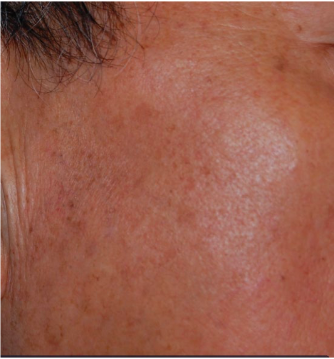 Close-up of a light brown facial rash near the hairline and cheek