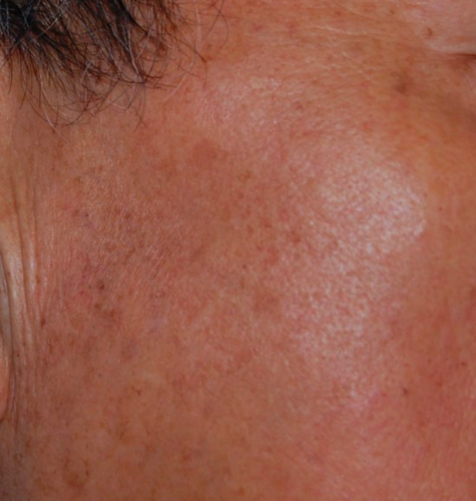 Close-up of a reddish-brown skin patch with a light, shiny spot on the cheek