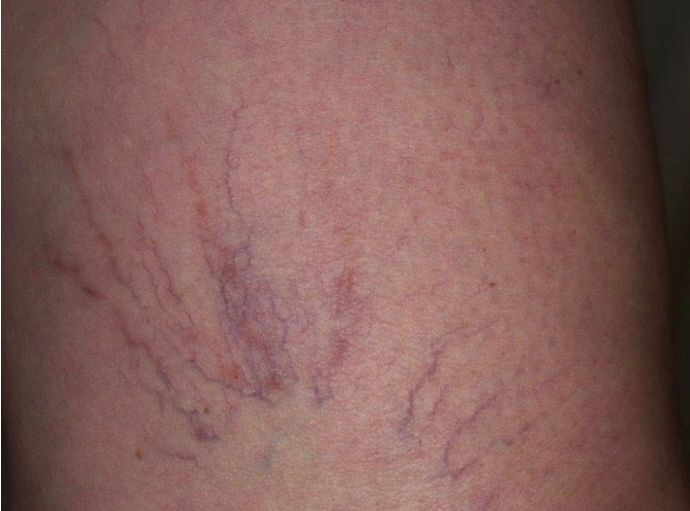 Close-up of pale skin with visible purple spider veins branching across it
