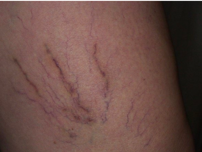Close-up of skin with visible purple-blue spider veins or varicose veins