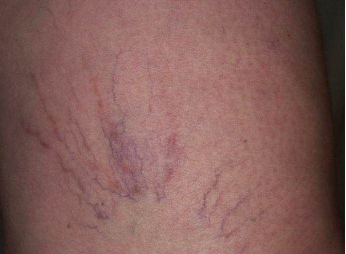 Close-up of skin with a purple spider vein pattern on a leg