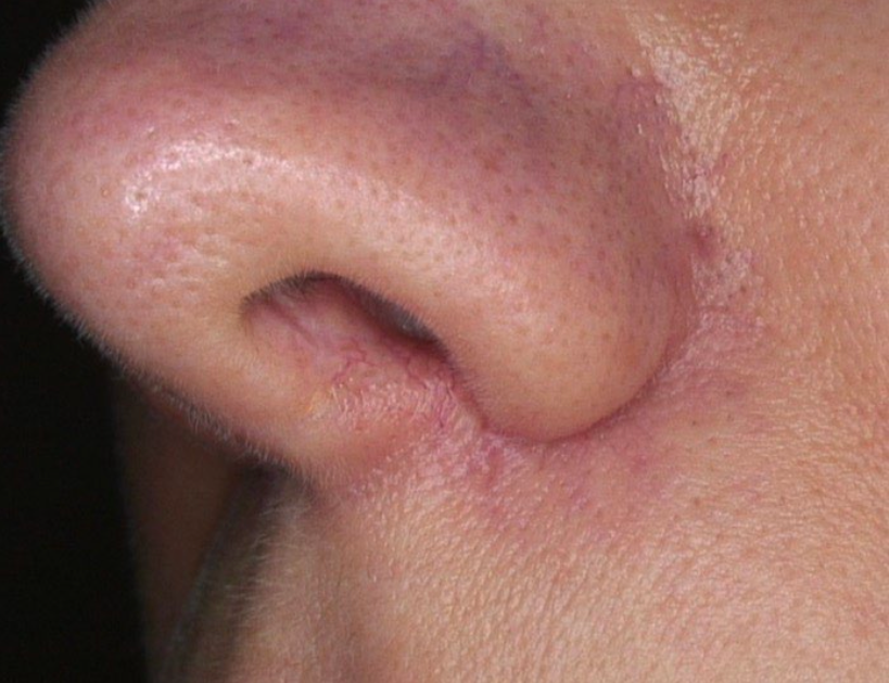 Close-up of a nose with a small red scratch near the nostril