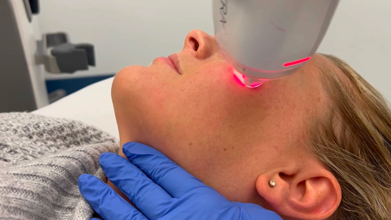 Person receiving a facial laser treatment while lying back, with red laser light on the cheek