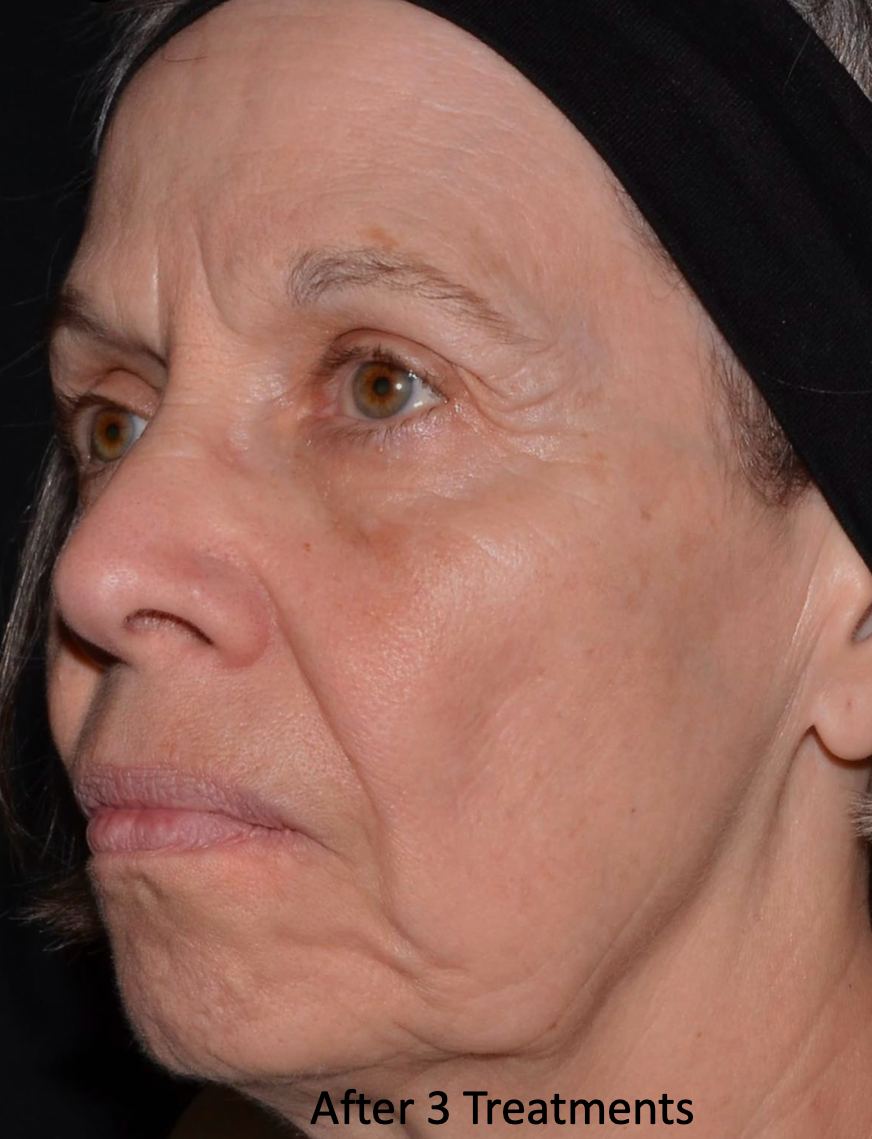 Close-up side profile of a woman’s face with text “After 3 Treatments” at the bottom.