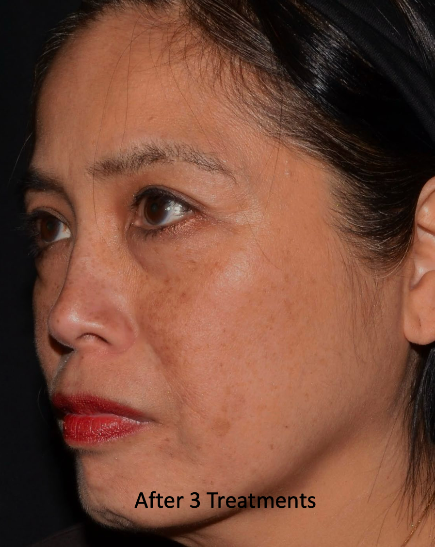 Close-up side profile of a woman’s face with visible skin spots; text reads “After 3 Treatments.”