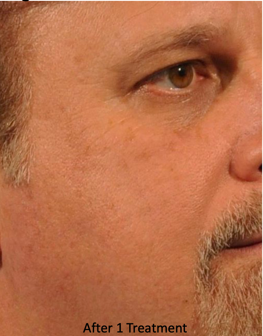 Close-up of a man's face showing skin after one treatment, with visible redness and texture changes