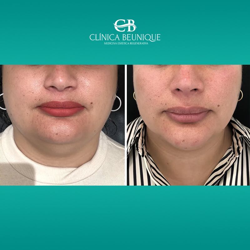 Fotografías faciales en primer plano, una al lado de la otra, antes y después del tratamiento, que muestran una reducción de la hinchazón y una piel más suave.