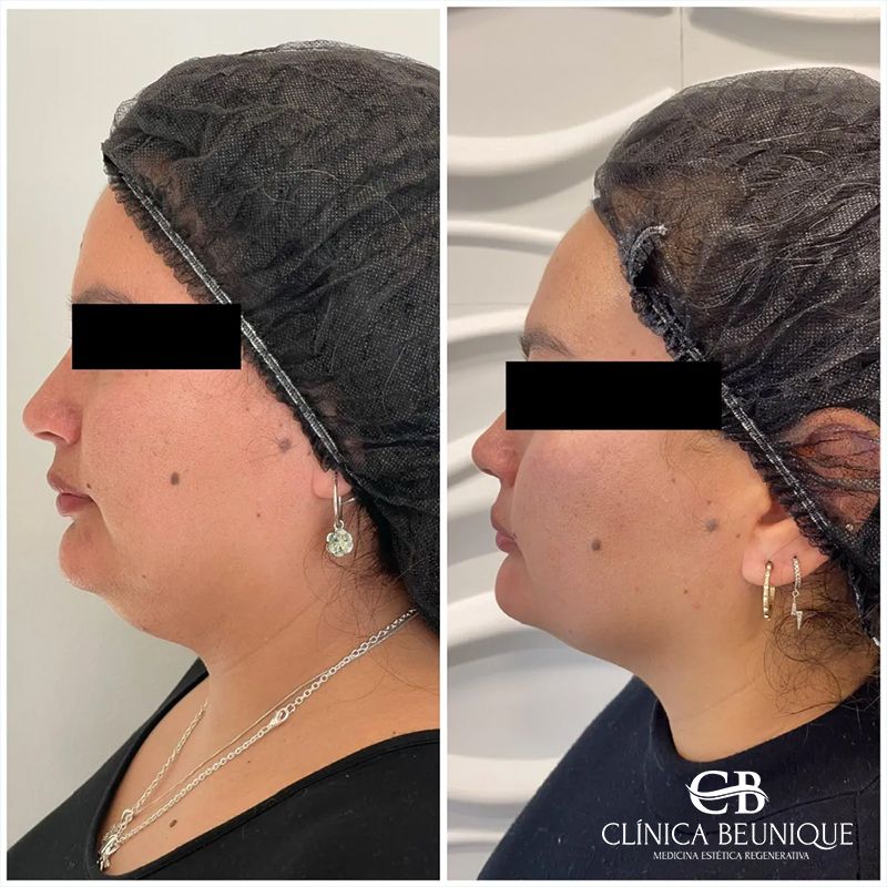 Fotos de perfil comparativas de una persona con gorro negro para el cabello antes y después de un tratamiento cosmético.