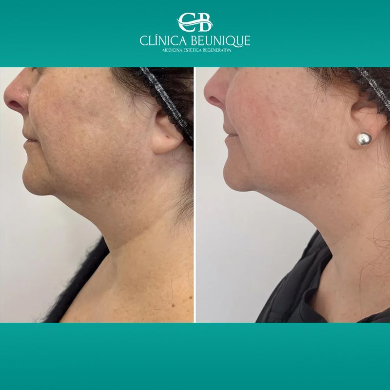 Fotografías de perfil comparativas que muestran la mandíbula y el cuello de una mujer antes y después del tratamiento.