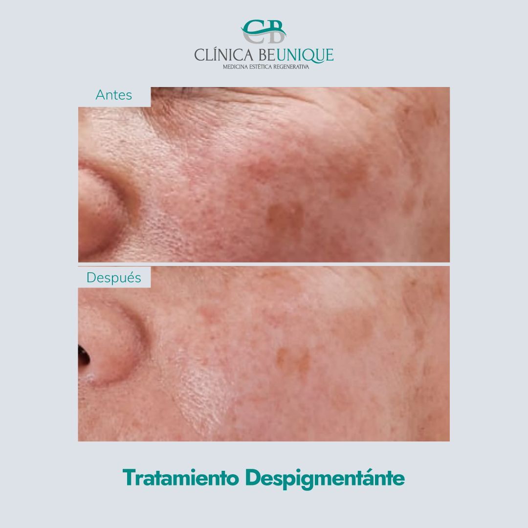Primer plano de la cara dividida que muestra las manchas de la piel antes y después del tratamiento despigmentante.