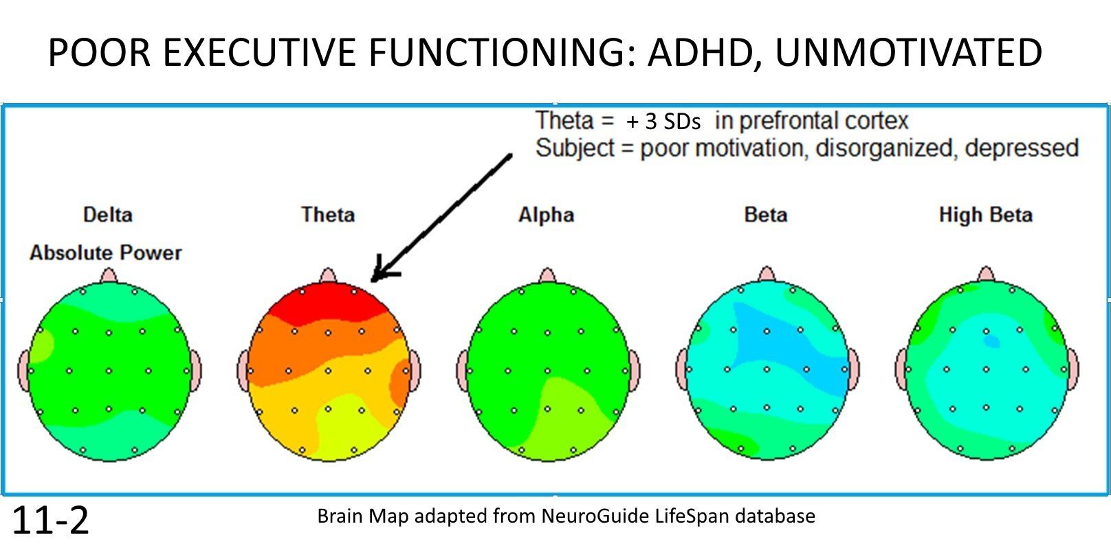 Brain activity maps labeled poor executive functioning: ADHD, unmotivated, with theta, alpha, and beta differences.