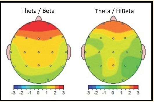 Two brain heatmaps labeled Theta/Beta and Theta/HiBeta with red, yellow, and green regions.