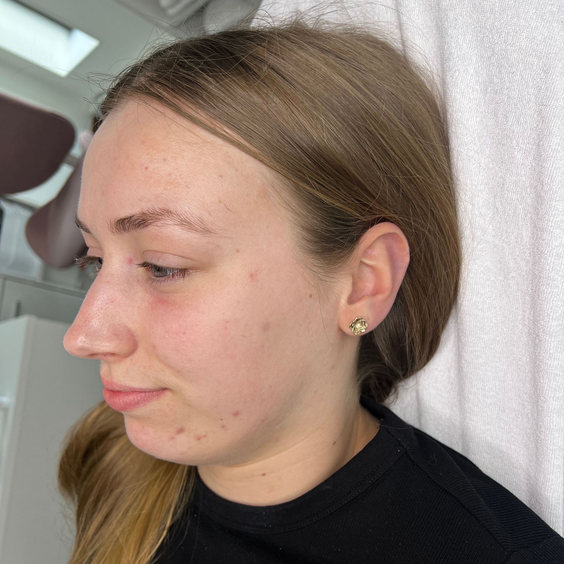 Resultaat gezichtsbehandeling bij Glow Spa in Drachten
