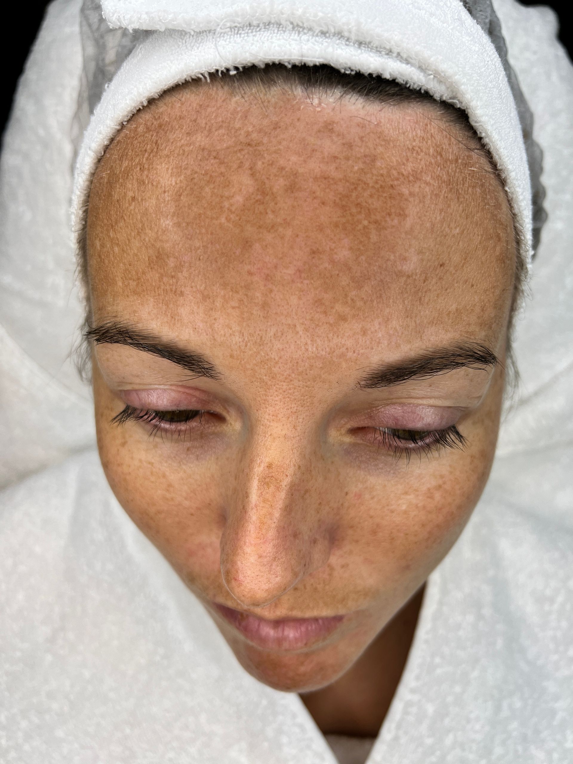 Resultaat gezichtsbehandeling bij Glow Spa in Drachten