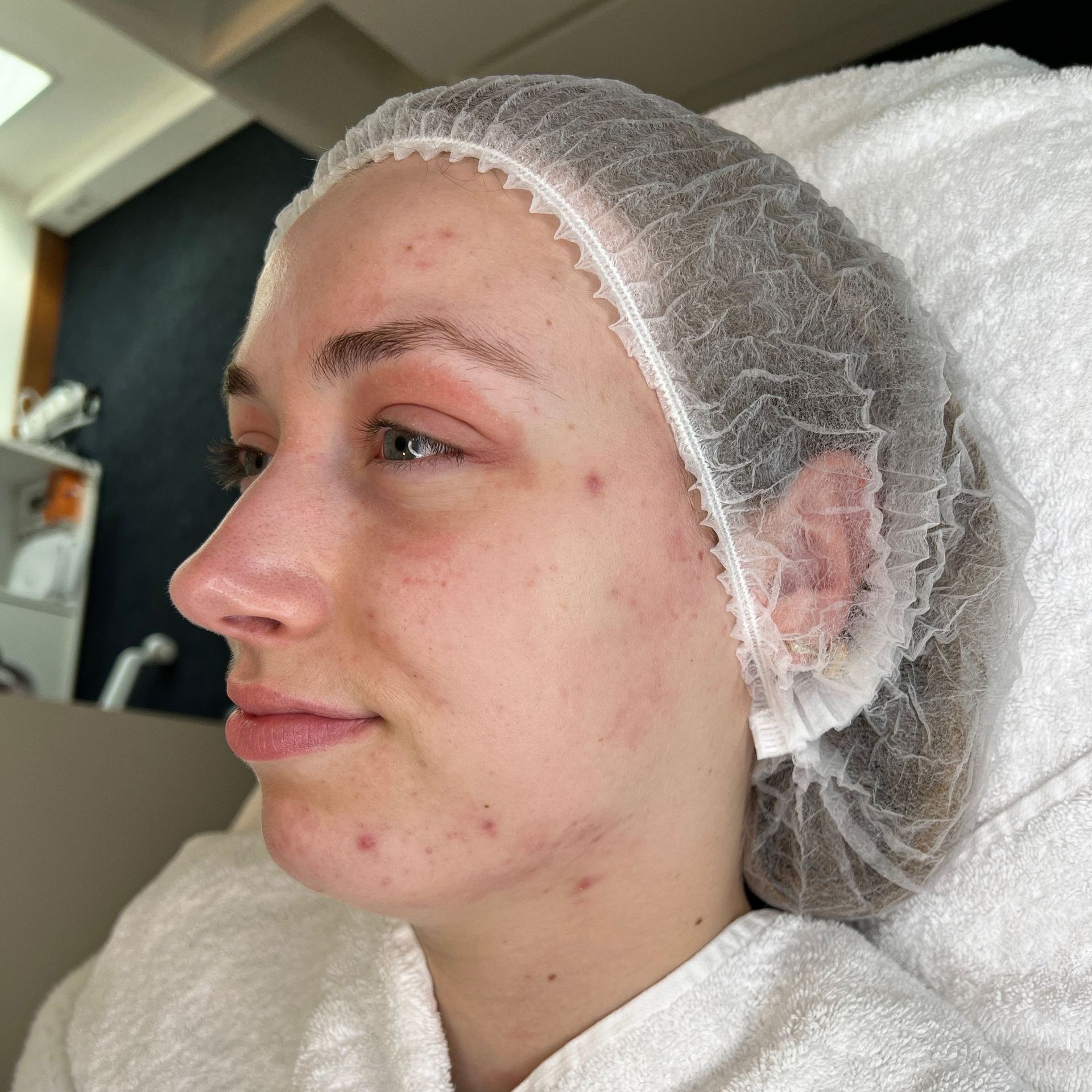 Resultaat gezichtsbehandeling bij Glow Spa in Drachten