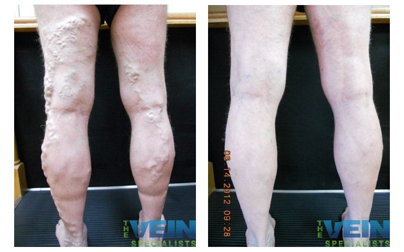 A before and after photo of a person 's legs with veins