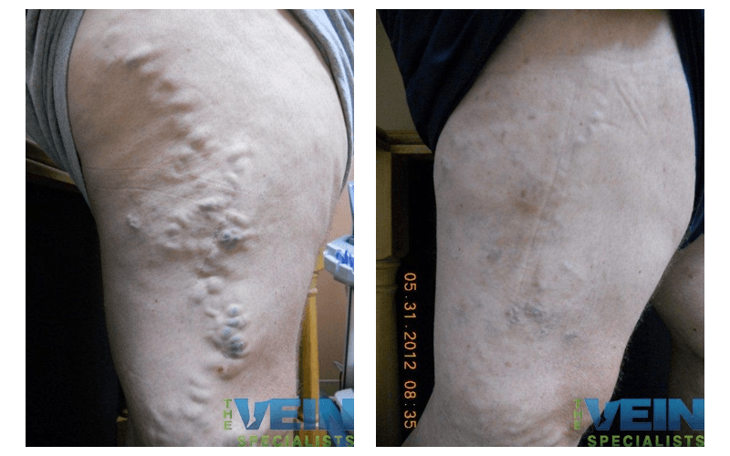 A before and after photo of a person 's leg