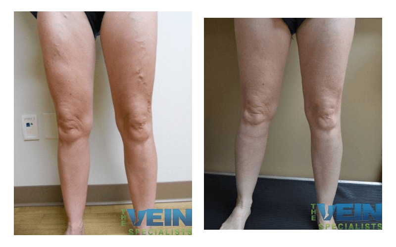 A before and after photo of a woman 's legs with varicose veins.