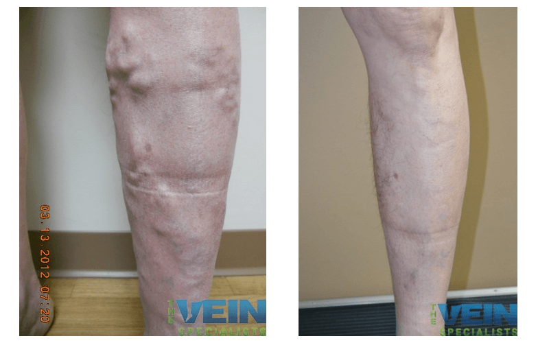 A side by side photo of a before and after treatment for legs.