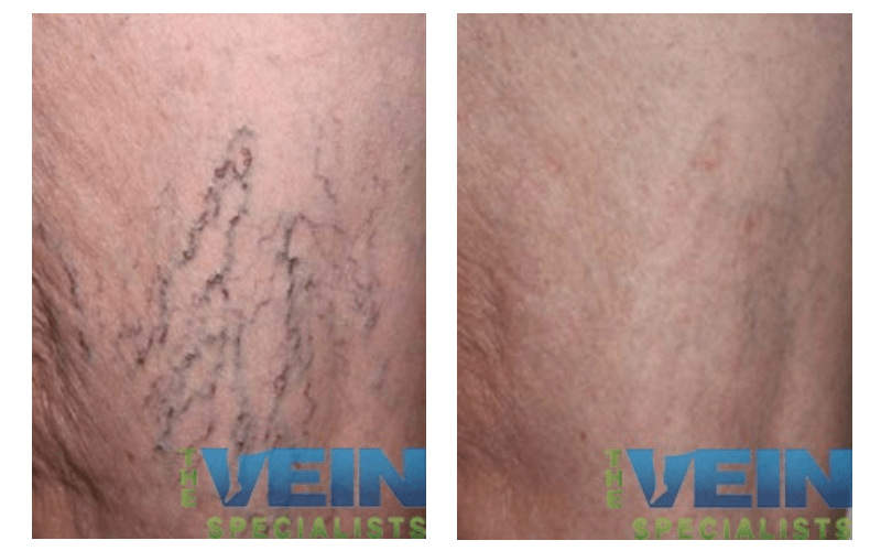 A before and after photo of a vein specialist
