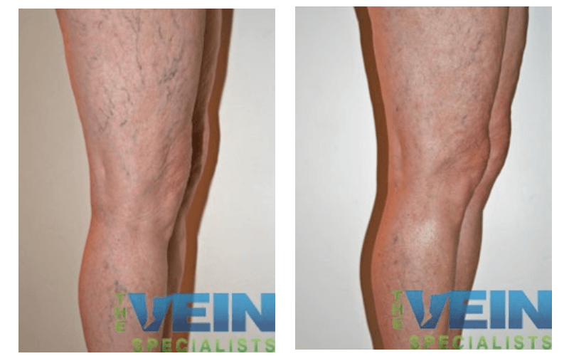 A before and after photo of a person 's legs with the words vein specialists