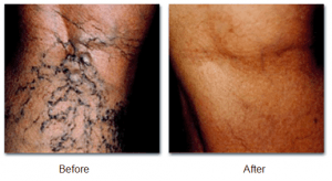 A before and after photo of a person 's leg