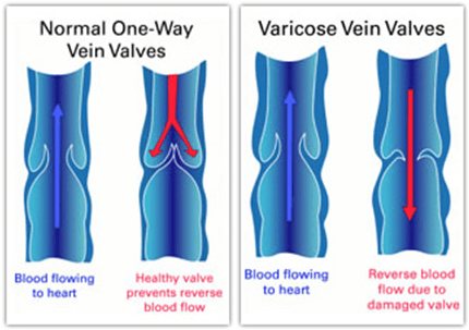A diagram of normal one way vein valves and varicose vein valves