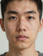 Acne and scarring concern