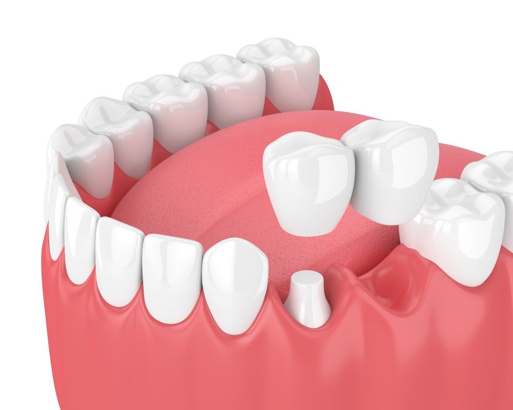 traditional fixed dental bridge | dentist near you | Dr. Ray T Chow Dentistry | Victoria Dentist