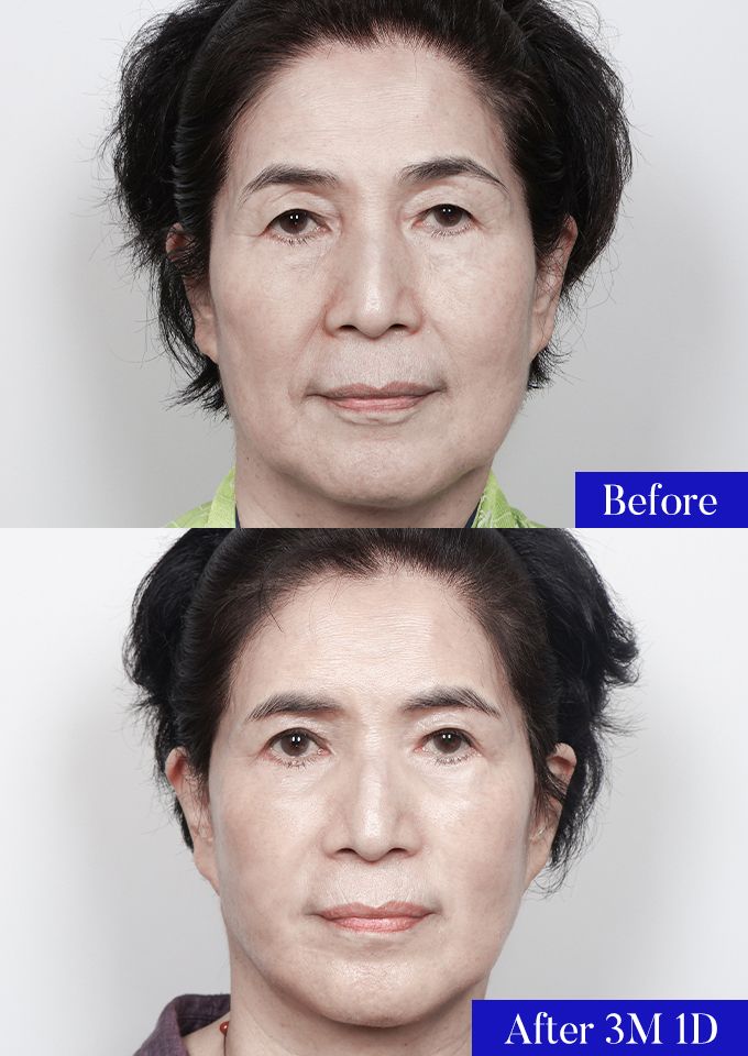 윌비성형외과 안면거상 전후사진