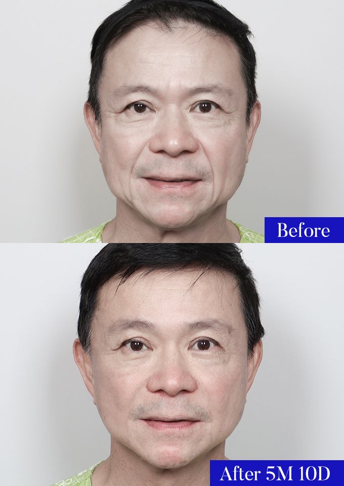 윌비성형외과 안면거상 전후사진