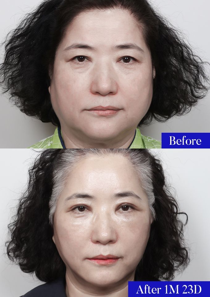 윌비성형외과 안면거상 전후사진