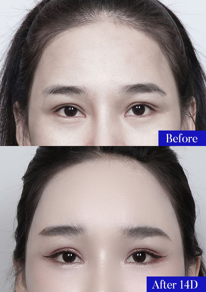 윌비성형외과 이마거상 전후사진