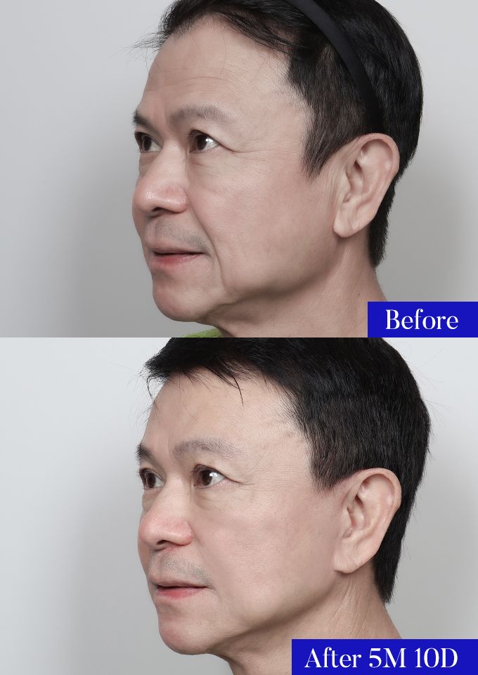 윌비성형외과 안면거상 전후사진