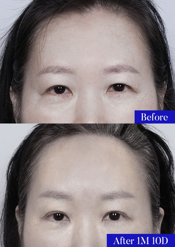 윌비성형외과 이마거상 전후사진