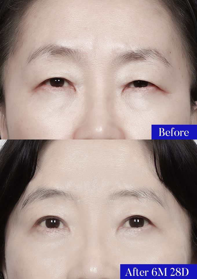 윌비성형외과 눈썹밑거상 전후사진