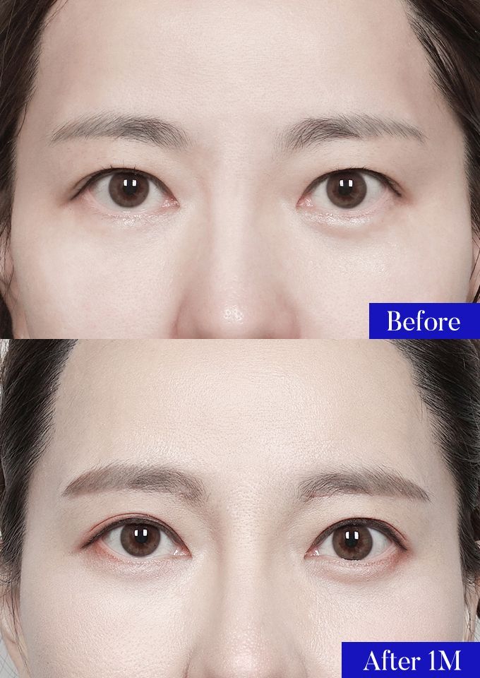 윌비성형외과 눈썹밑거상 전후사진