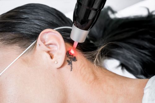 A Woman Is Getting A Tattoo Removed From Her Neck - Latrobe, PA - Laser180