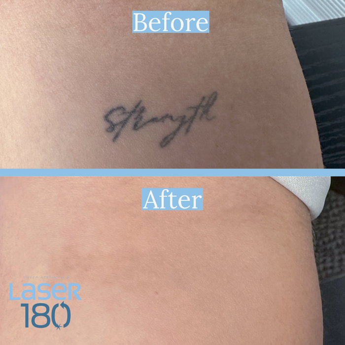 A Woman Is Getting A Tattoo Removed From Her Stomach - Latrobe, PA - Laser180