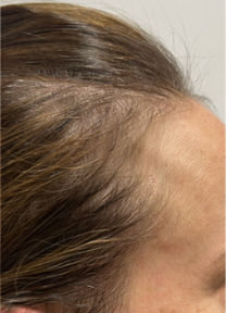 Close-up of a person’s forehead and hairline, showing thinning hair at the temple.