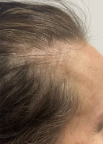 Close-up of a person’s hairline and forehead with thinning hair near the temple