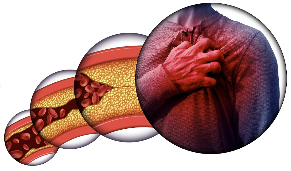 Illustration of blocked artery and chest pain representing heart attack risk
