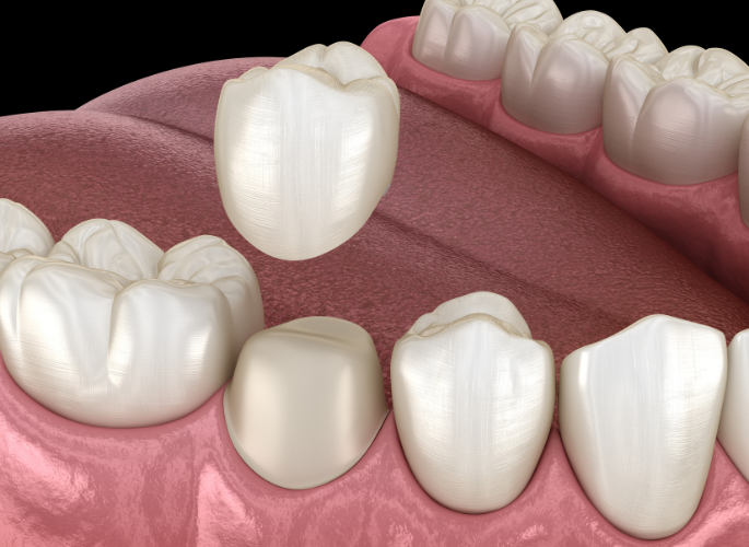 Woman smiling confidently | Get dental crowns in Four Corners, FL.