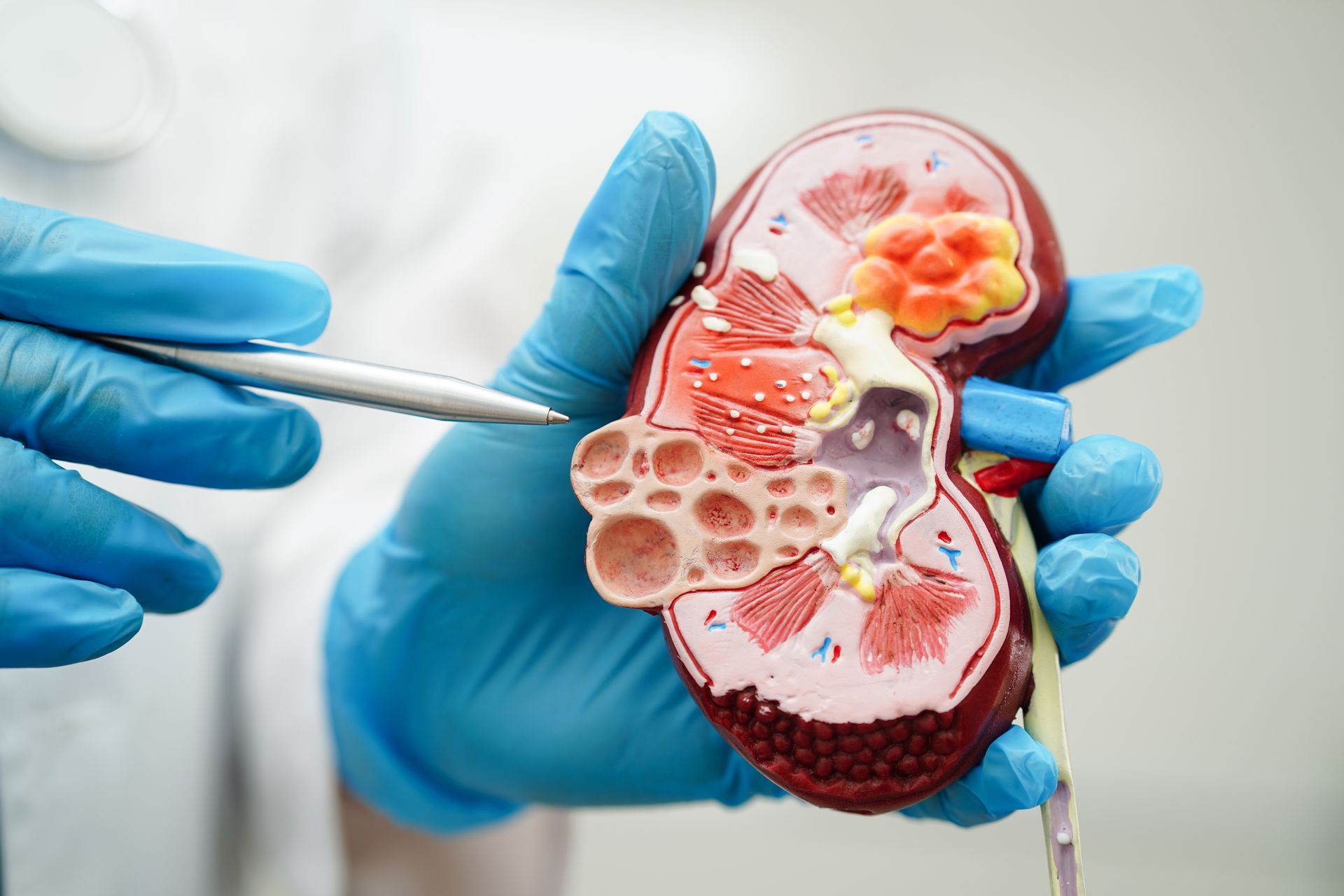 A kidney doctor holds an anatomical model showing structural damage from chronic renal disease. A kidney doctor holds an anatomical model showing structural damage from chronic renal disease.